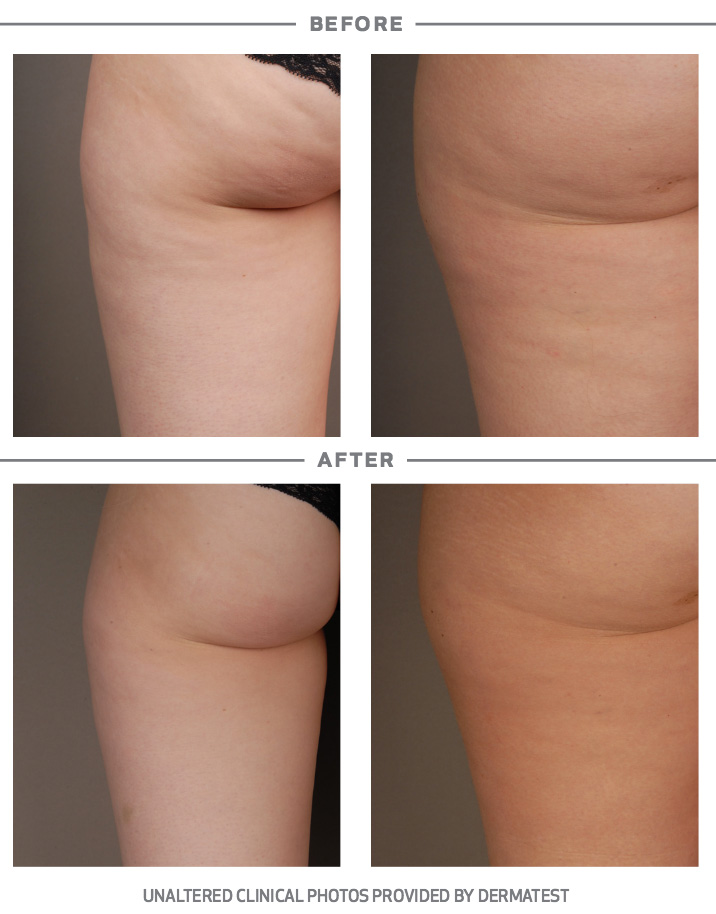 Reduces the Appearance of Cellulite
